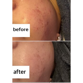 プラズマシャワーでアクネ菌撃破！！