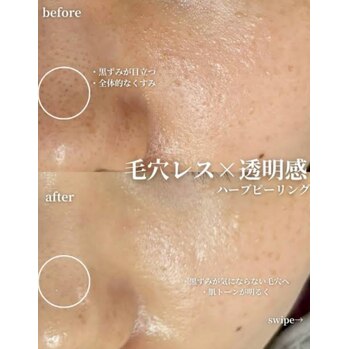 ハーブピーリング後の過ごし方♪