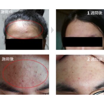 プラズマシャワーの驚異的パワー^_^