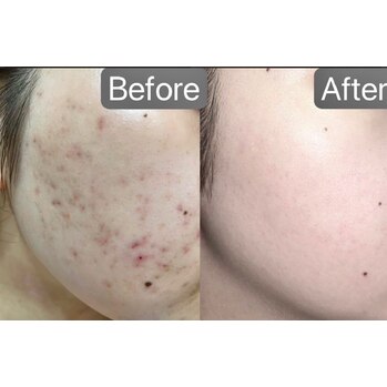 ラジオ波で代謝促進^_^