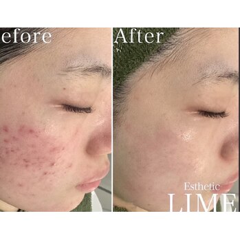 エステダーマと毛穴洗浄の相乗効果^_^